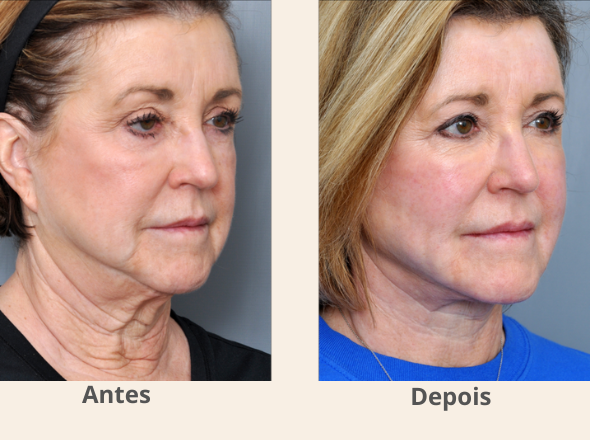 tratamentos 590 x 440 pescoço tratamentos 590 x 440 pescoço